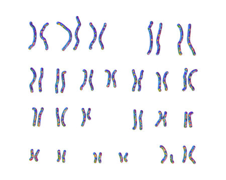 Karyotype of Prader-Willi syndrome