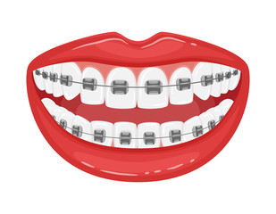 Open mouth with braces on the teeth. Straight white teeth with red lips. Orthodontic treatment.Detailed design element for booklets and flyers.Smile. Isolated on white. Flat style. Vector illustration