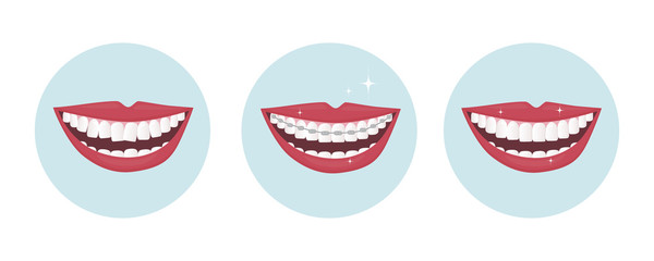 Human smile with wide open white and straight teeth with brackets. Dental service - Orthodontic treatment and straightening of teeth. Example of the mouth before and after alignment. vector 