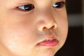 Naklejka premium sickness Asian baby boy face