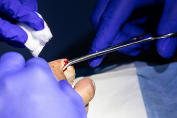 Series of ingrown toenail treatment. Medical doctor cut and extract toenail infection using forcep scissor
