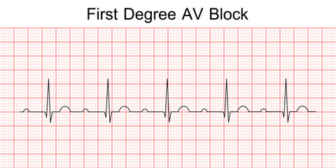 Electrocardiogram show first degree AV block pattern. ECG. EKG. Vital sign. Heart beat. Life line. Medical healthcare symbol.