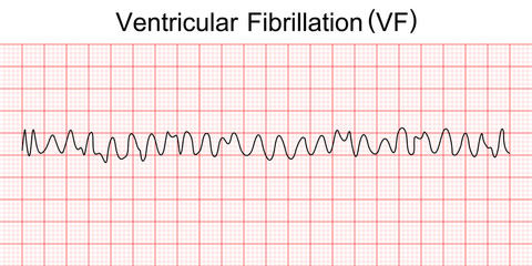 Electrocardiogram show ventricular fibrillation (VF) pattern. Cardiac fibrillation. Heart beat. CPR. ECG. EKG. Vital sign. Life support. Defib. Emergency. Medical healthcare symbol. - obrazy, fototapety, plakaty