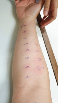 Arm examine with allergy skin prick test rash reaction aero dust mite sensitive
