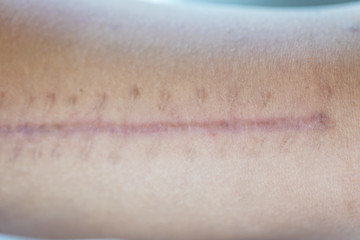 A scar is an area of fibrous tissue that replaces normal skin after an injury on skin.	
