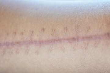 A scar is an area of fibrous tissue that replaces normal skin after an injury on skin.	
