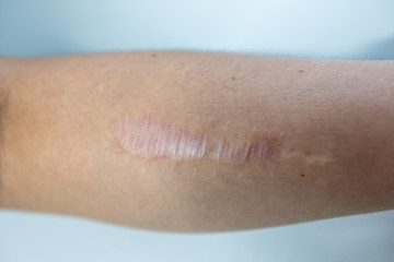 A scar is an area of fibrous tissue that replaces normal skin after an injury on skin.	
