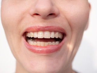 Middle aged woman laughs on white background showing perfect white teeth
