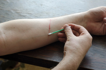 Adult A man uses a cotton swab to treat the wound on his forearm on his own.