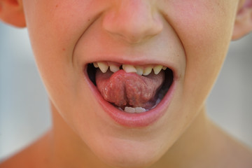  Child with milk tooth ready to fall