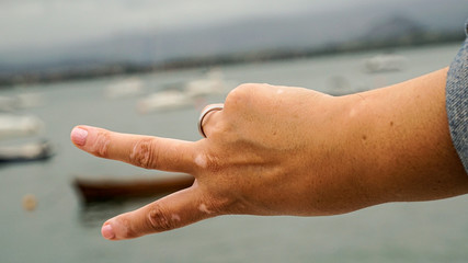 gestos de las manos con vitiligo, dedos con manchas en la piel