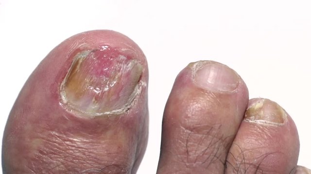 Panning of a big toenail with Onychomycosis, a fungal infection causing yellowing of the toenail.