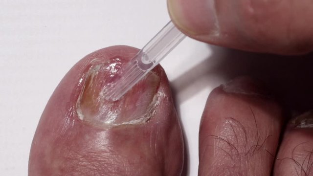 Hand applying antifungal polish to a big toe nail affected with Onychomycosis toe fungus.