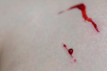 Close up of skin damage bleeding