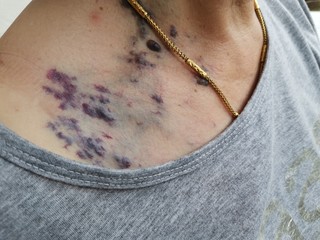 young woman with  Capillary