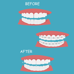 teeth with braces.Jaws with braces. Orthodontics. Dental care, teeth care. Vector.