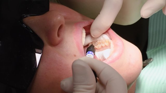 Applying resin based composite filling on tooth. Young woman at dental clinic. Female dentist with assistant treating cavities in a patient mouth in modern dental office.