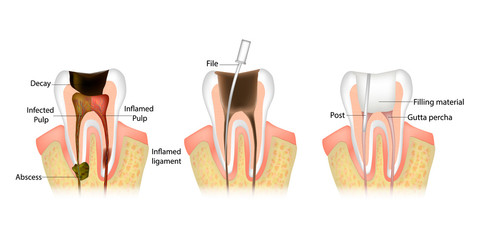 Endodontic root canal treatment process.