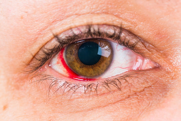 Detail of woman brown eye with the damage and blood in eye