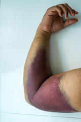 Bicep tear or strain, tendon injuries on a muscular man hand. Trauman or trauma injury. Health and...