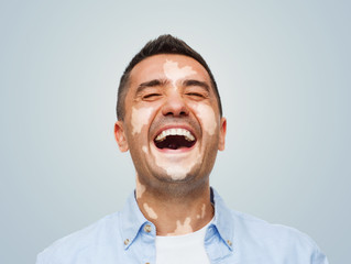 diversity, skin pigmentation and people concept - happy laughing man with vitiligo