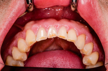 serious teeth wear at a young male