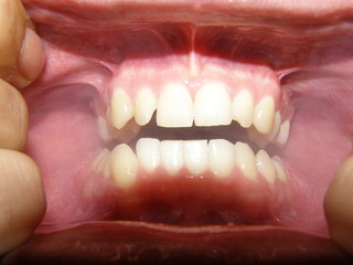 Close up of teeth and inside cheeks