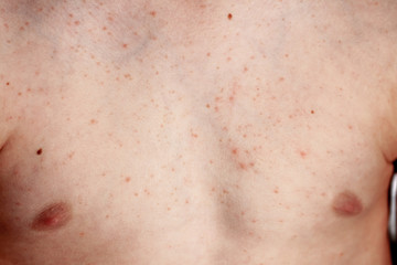 Close up image of a little boy's body suffering severe urticaria, nettle rash also called hives