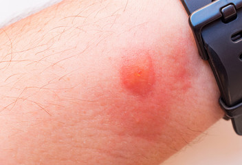 Fototapeta premium Insect bite on a men's hand. Allergic reaction.
