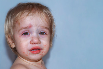 Chickenpox disease, with fever and runny nose. Boy sick on his face. Chickenpox virus, chicken pox outbreak in children.