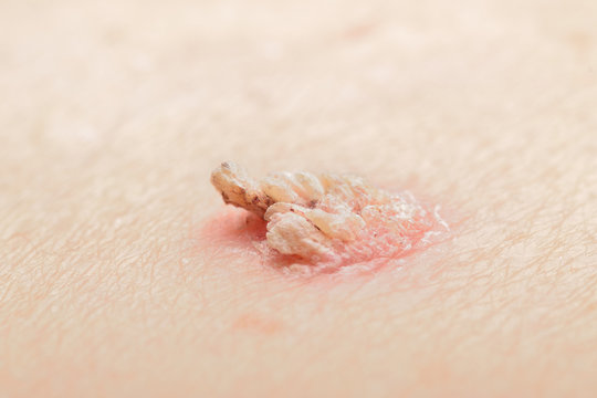 Heraustretende Papulae bei Warze Verruca vulgares macro