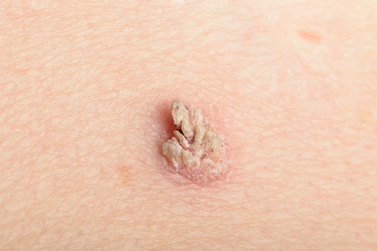 Heraustretende Papulae bei Warze Verruca vulgares