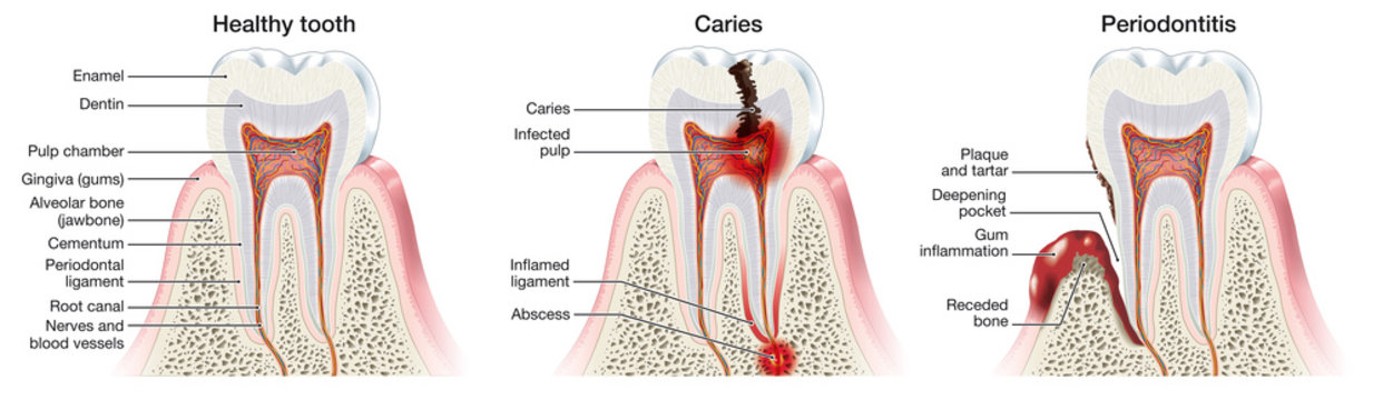Healthy tooth, caries and periodontitis, meidically illustration