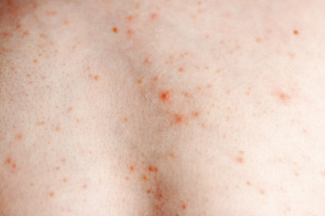 Close up image of a little boy's body suffering severe urticaria, nettle rash also called hives