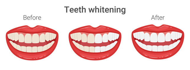 Even yellow and white teeth in the mouth. Teeth whitening. Mouth in a smile. Aesthetic dentistry. Comparison before and after. Healthy lifestyle, dental care. Isolated flat vector illustration