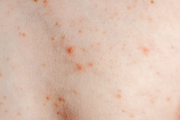 Fototapeta premium Close up image of a little boy's body suffering severe urticaria, nettle rash also called hives