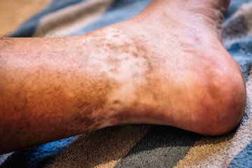 Closed plane of an ankle with lack of skin pigmentation.