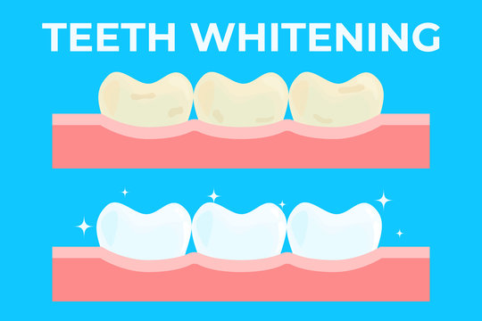 Teeth whitening or bleaching vector illustration. Concept of dental healthcare, stomatology care, professional tooth cleaning service.