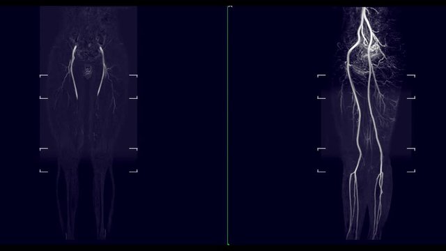 Compare of Magnetic resonance angiography or MRA of the aorta, iliac, and femoral arteries Coronal and MIP .