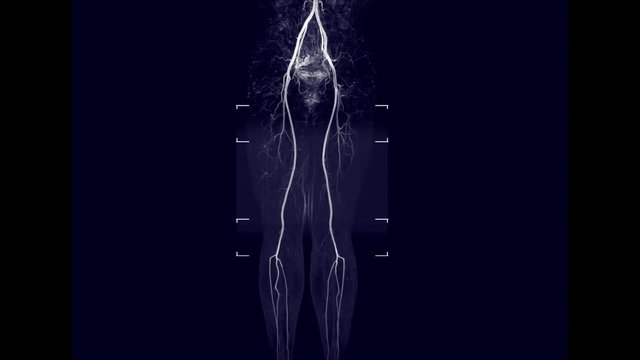 Magnetic resonance angiography or MRA of the aorta, iliac, and femoral arteries MIP technique .