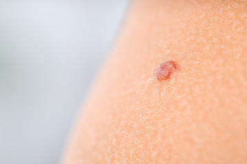Human skin with mole, closeup