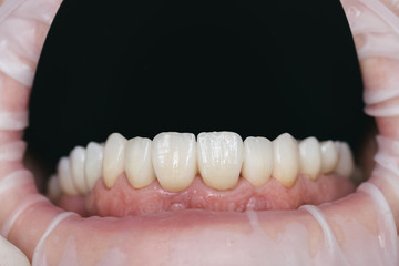 Closeup photo with zirconium artificial teeth. Zirconium crowns