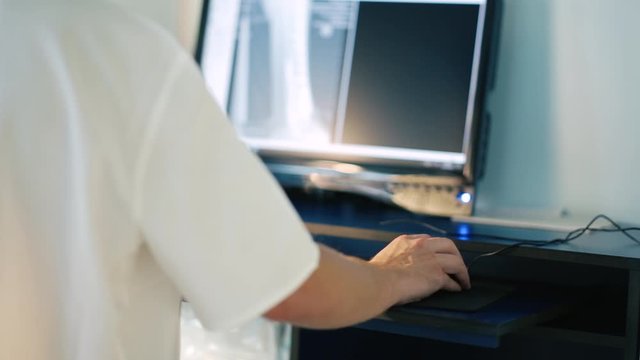 hand of a traumatologist uses a computer mouse, working with a computer - pictures of a bone fracture.