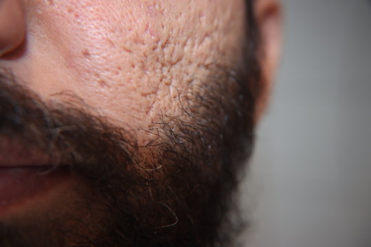 Beard man has damaged face skin from deep acne scars. also black beard on white skin.Bartmann hat Gesichtshaut durch tiefe Aknenarben besch&auml;digt. und hat schwarzer Bart auf wei&szlig;er Haut.