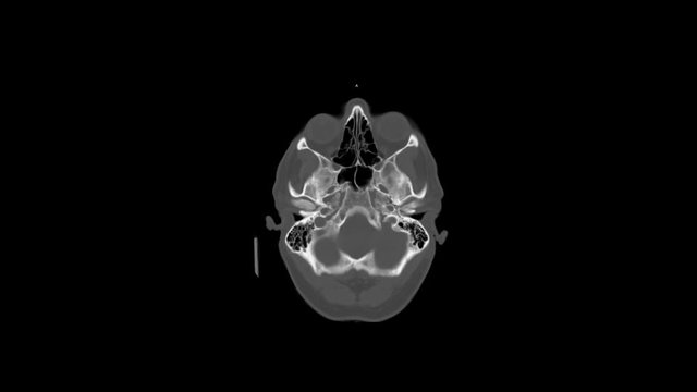 Brain and Skull CT scan