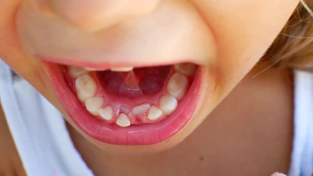 Child tries to pull out his second tooth with his fingers