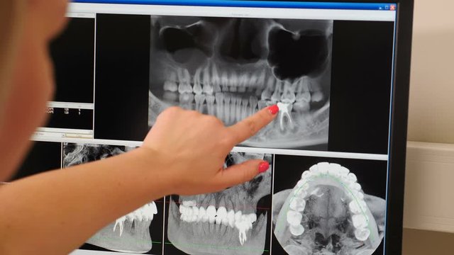 Jaw MRI at modern dental clinic. Female dentist showing MRI image on computer screen an x-ray of patient. Close-up shot. Diagnostic medical equipment in modern dentistry. 4 k video