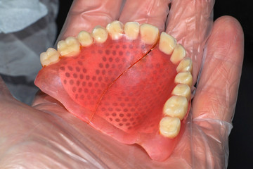 Removable denture with cast reinforcement on hand in gloves. Full upper plastic prosthesis with fracture. Broken old plastic teeth.