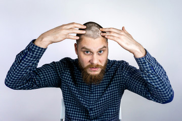 sad Man with alopecia on head, touching hair and looks in the mirror. Spot Baldness, Hair fall...