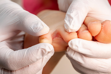 Doctor little girl's foot with fungus infection